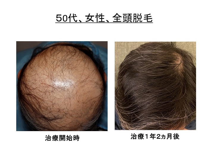 円形脱毛症　病院